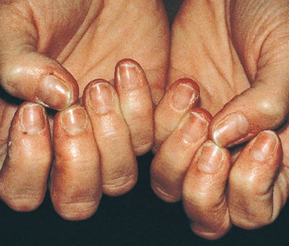 What Are Brittle Nails?
