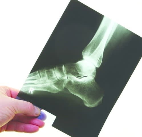 Freezing Temperatures Treat Chronic Foot Pain