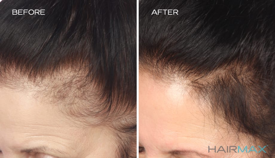 HairMax: Laser Devices for Hair Growth