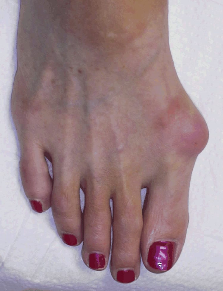 The Bare Bones on Bunions