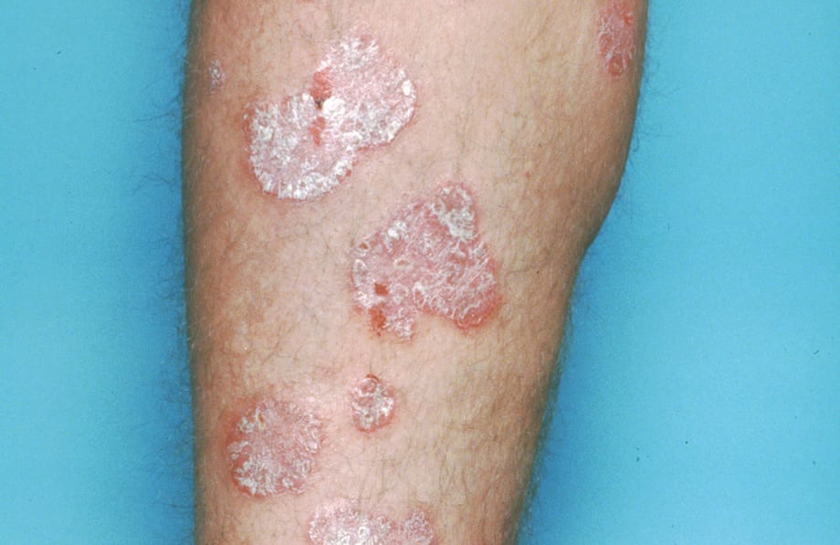 Under the Microscope: Psoriasis