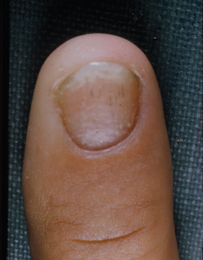 Shedding Light on Psoriasis