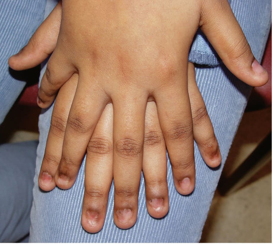 Under the Microscope: Pterygium