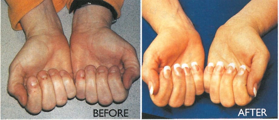 Strategies for Handling Nail Biter Clients