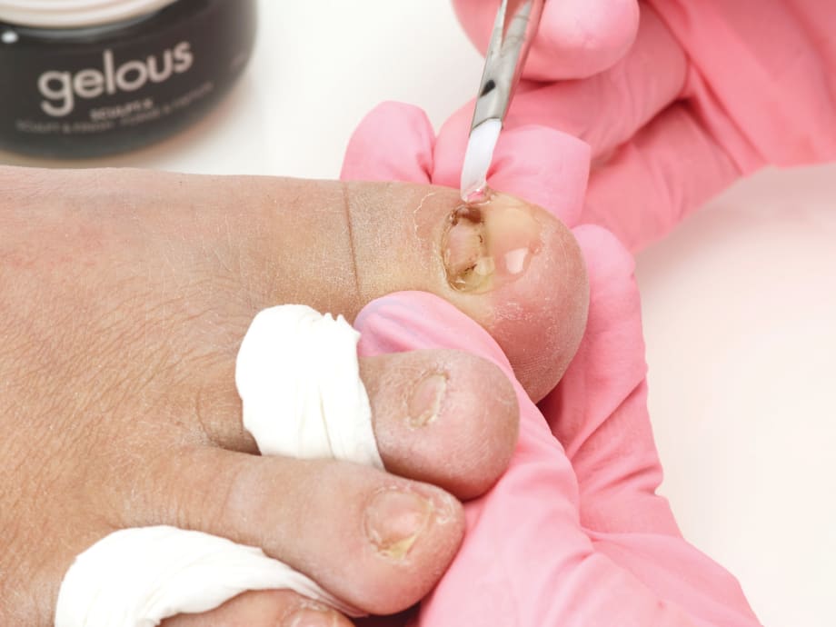 How to Repair Toenails with Gel