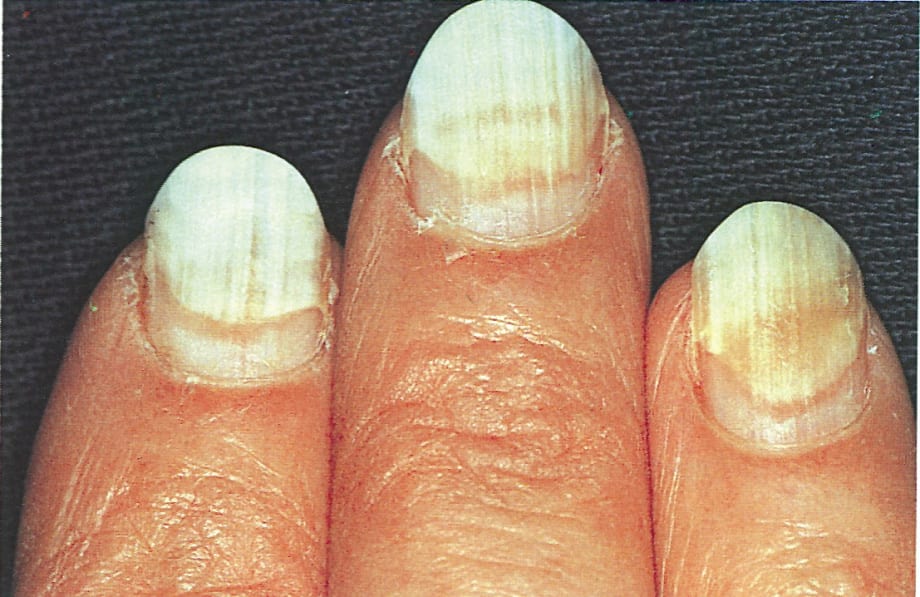 Nail Separation Anxiety