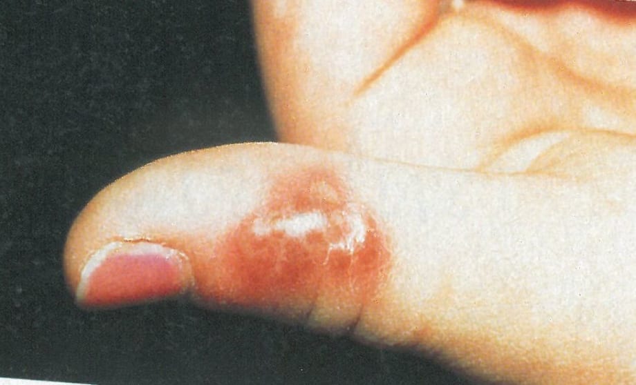 Woman Awarded $3.1 Million After Contracting Herpes at Salon