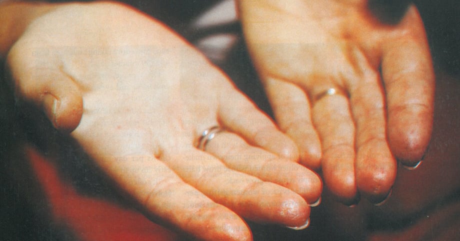 Raynaud’s Phenomenon: A Tale of Two Clients
