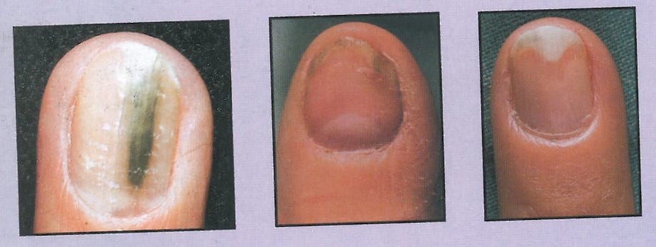 Debunking the Fungus Myth