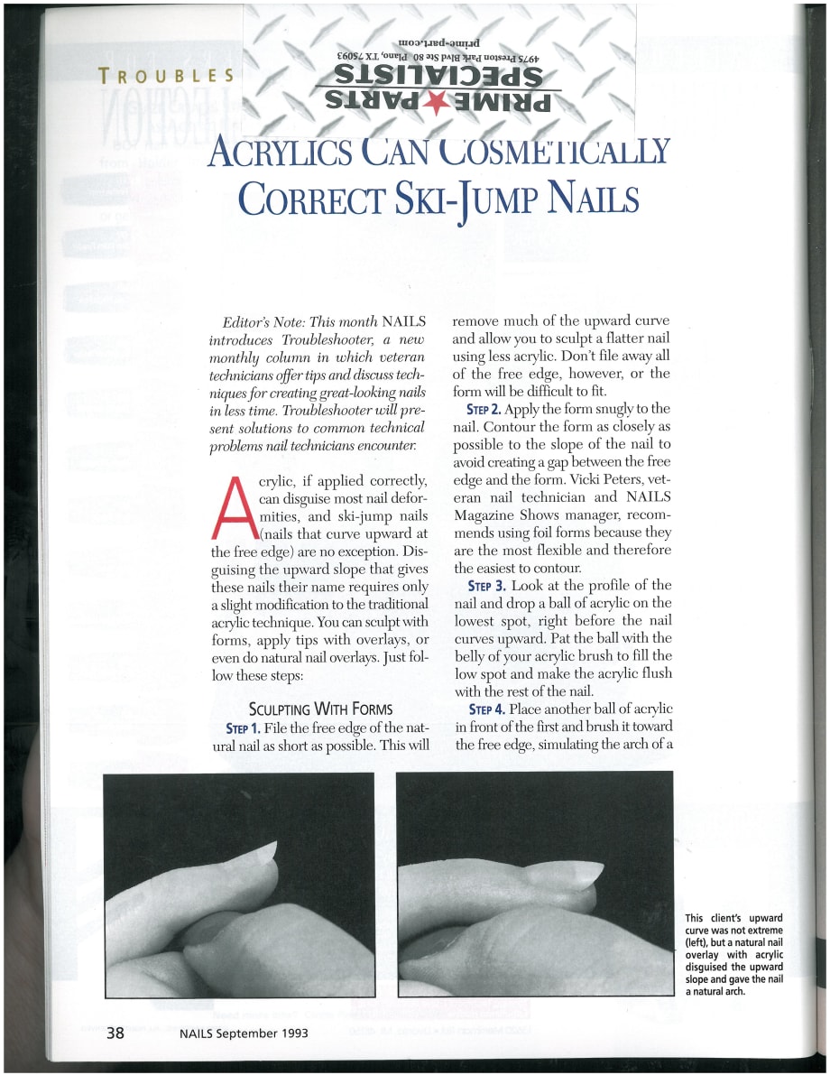 Acrylics Can Cosmetically Correct Ski-Jump Nails