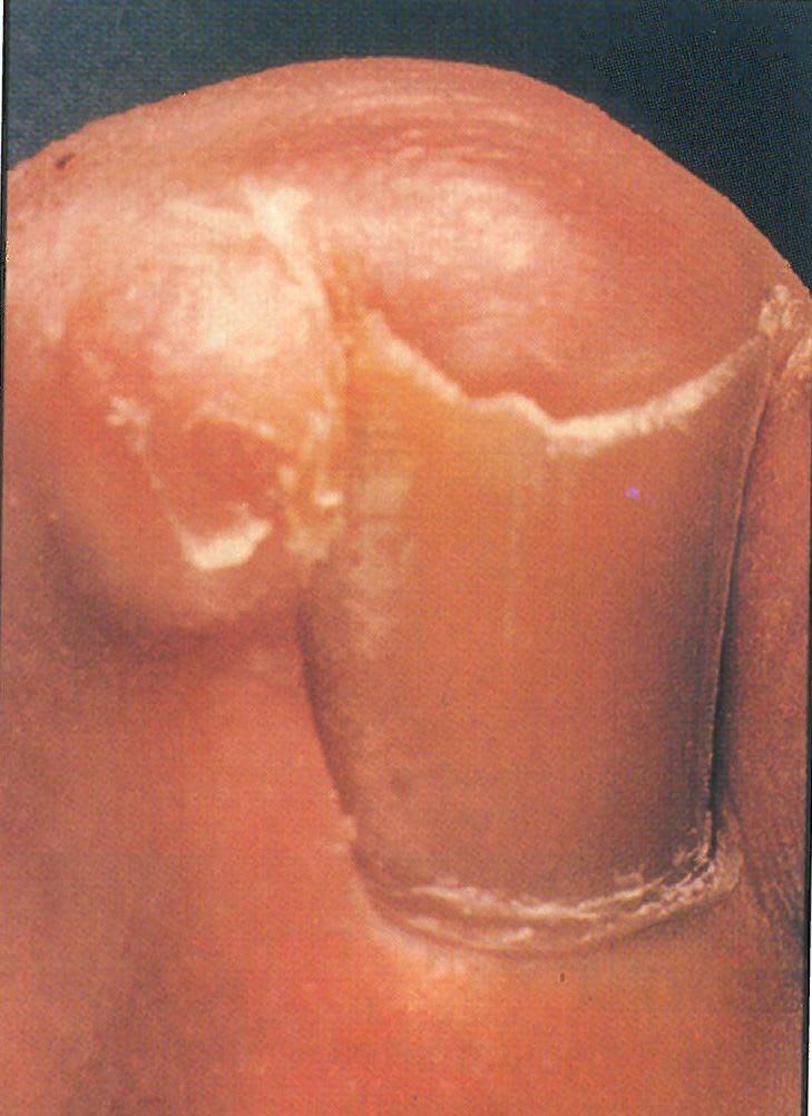 Ingrown Nails Are Preventable