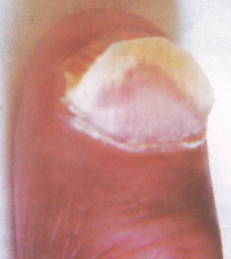 Ask the Nail Doctor: Nail Separation