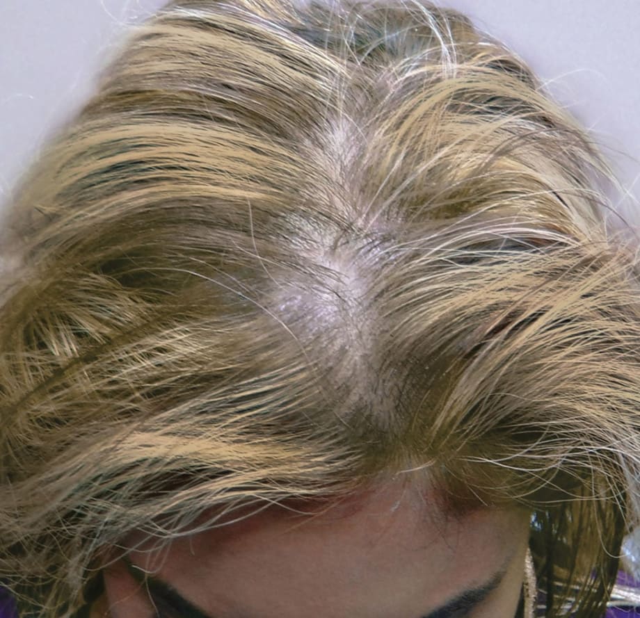 Before and Afters with SureThik Hair Thickening Fibers