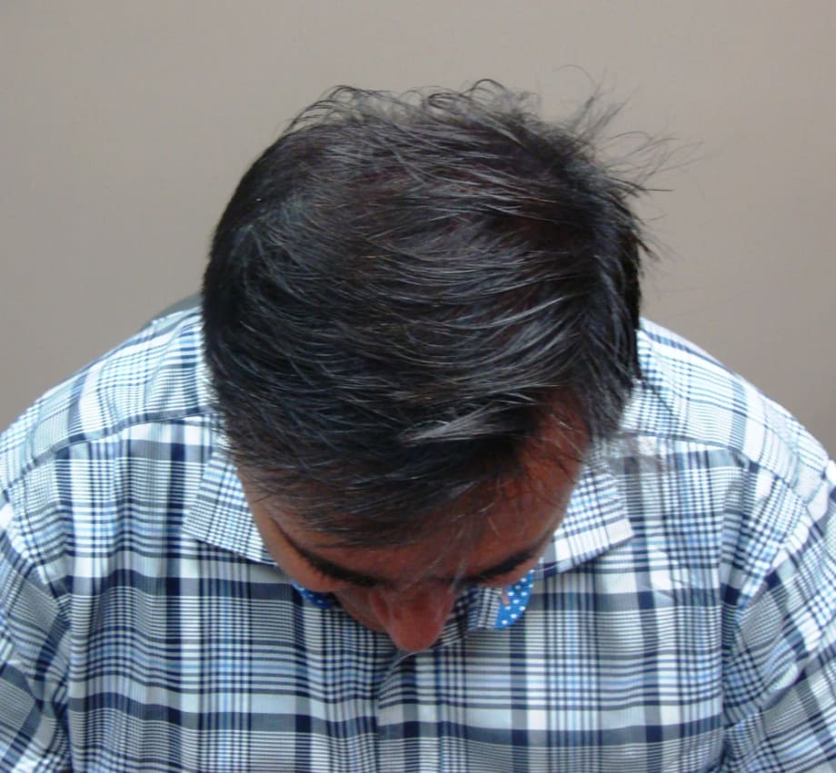Before and Afters with SureThik Hair Thickening Fibers