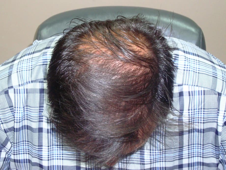 Before and Afters with SureThik Hair Thickening Fibers