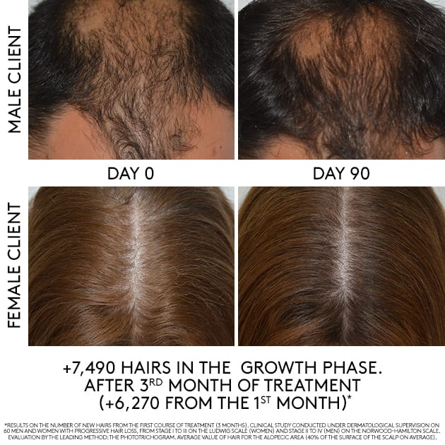 3 Reasons Why Hair Loss Should be a Priority in Your Salon