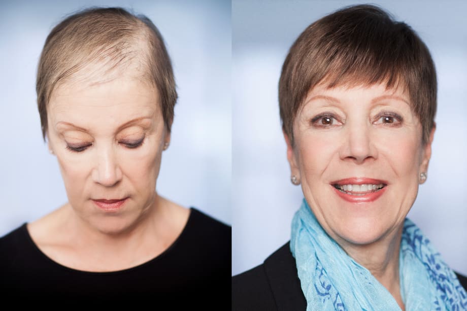 Filling the Void: A Solution to Hair Loss and Thinning