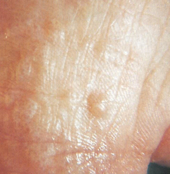 It is Athlete’s Foot Or Eczema?