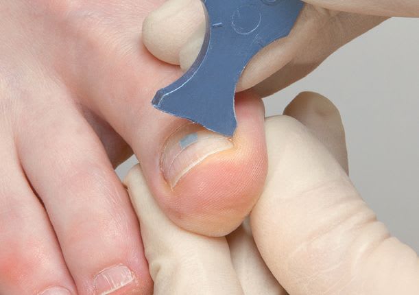 Something to Talk About: Ingrown Toenails