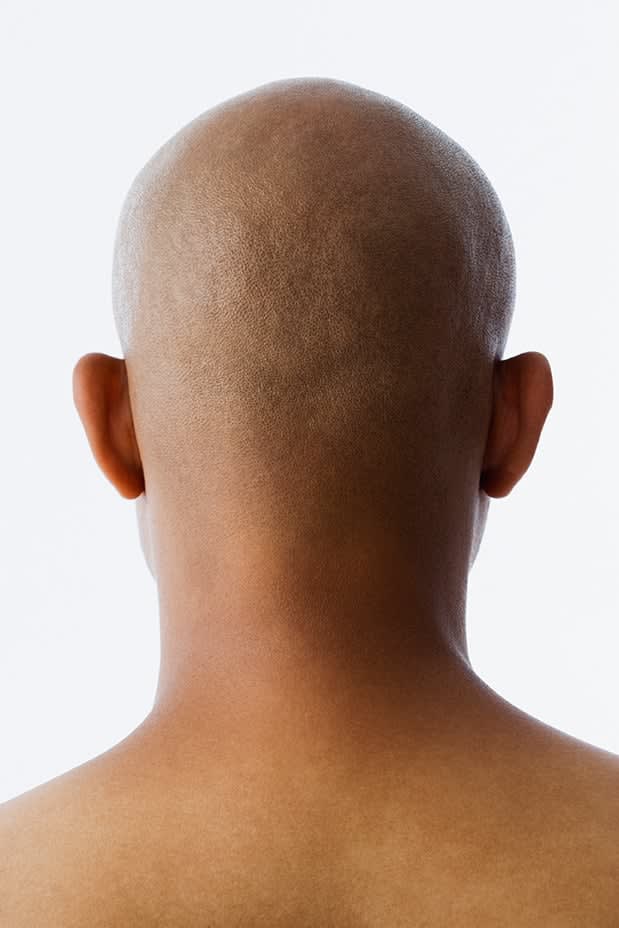 Did you hear? Study Finds Plucking Hair Can Help Treat Baldness