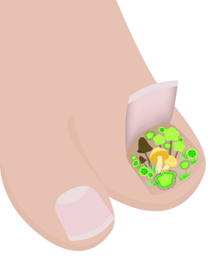 Chemist’s Corner: Antifungal Treatments