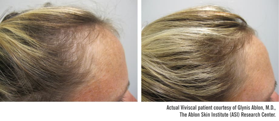 Q&A with Viviscal Professional