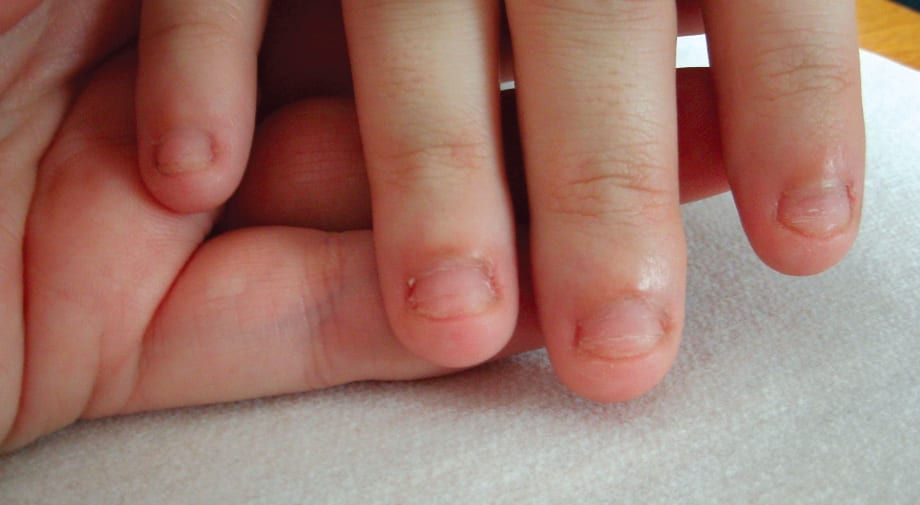 A Bridge Over Bitten Nails