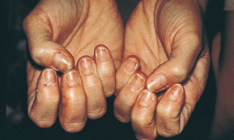 Under the Microscope: Brittle Nails