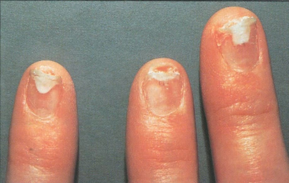 Clients And Technicians Can Live With Contact Dermatitis