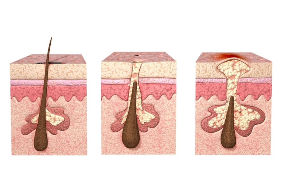 3 Things You Didn't Know About Enlarged Pores