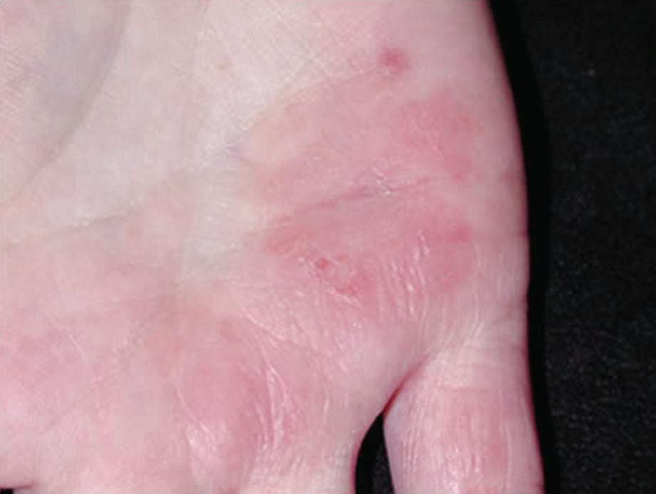 What Is Eczema?