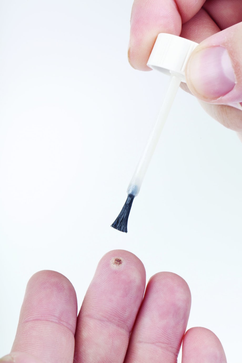 Something to Talk About: Warts