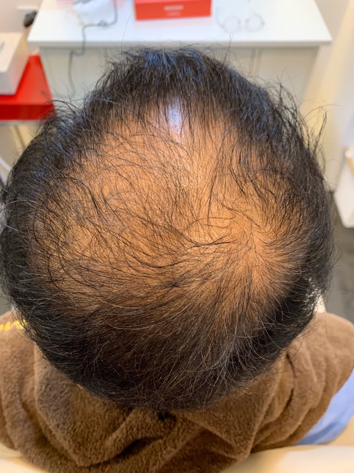 Histemo Treatment System Creates a Healthy Scalp Environment to Prevent Hair Loss