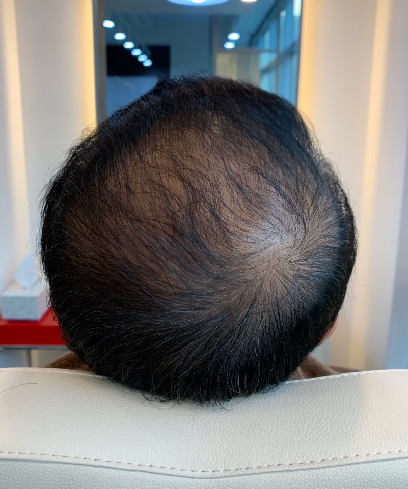 Histemo Treatment System Creates a Healthy Scalp Environment to Prevent Hair Loss