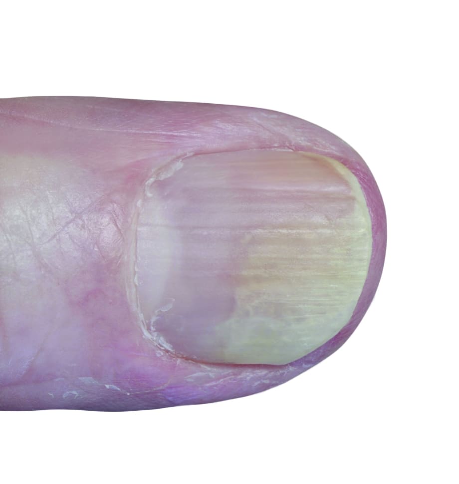 Something to Talk About: Psoriasis of the Nail
