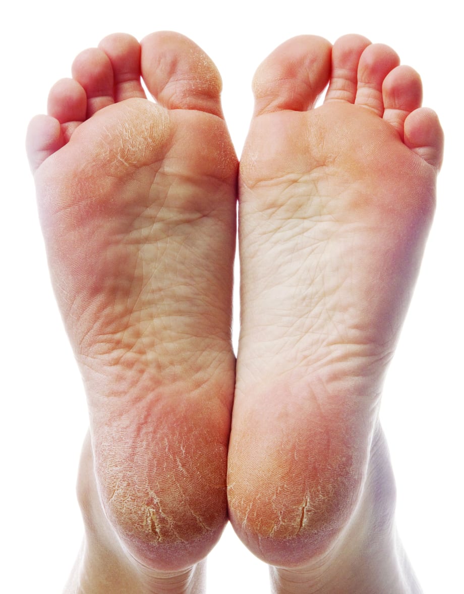 Something to Talk About: Cracked Heels