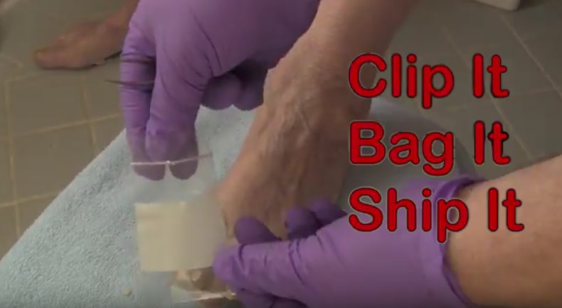 Send In Your Fungal Nails With the MediNail OnychoTest