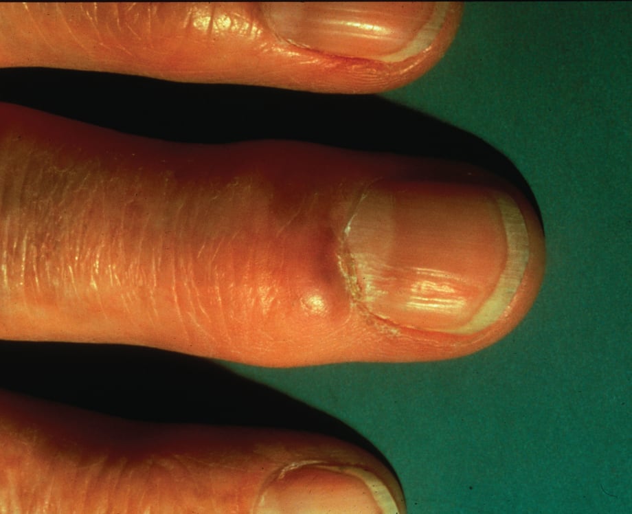 What Are Myxoid Cysts?
