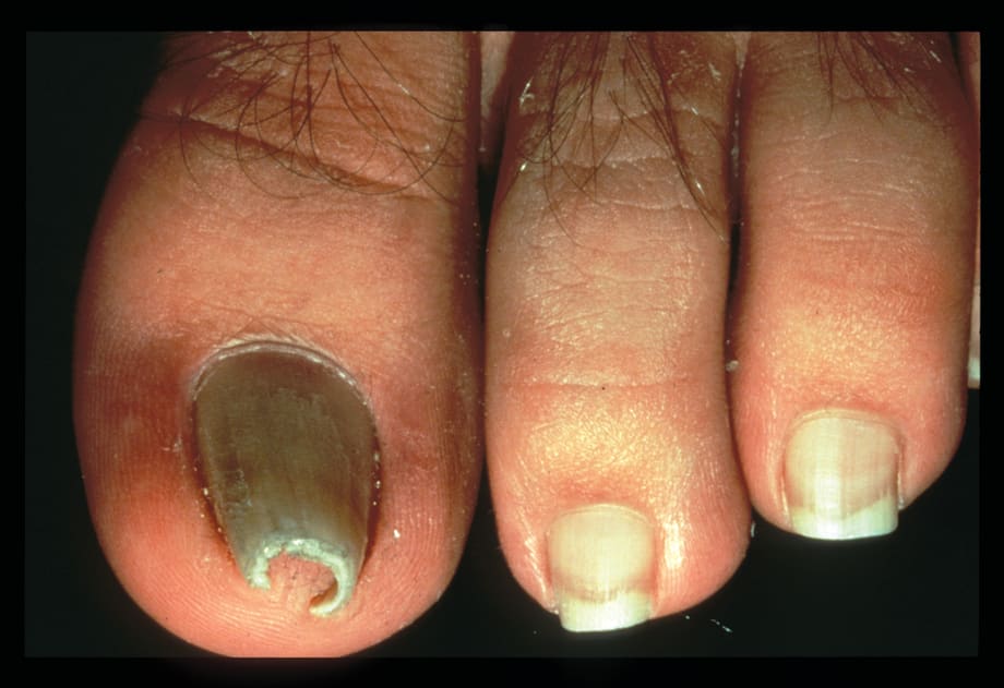 Under the Microscope: Pincer Nails