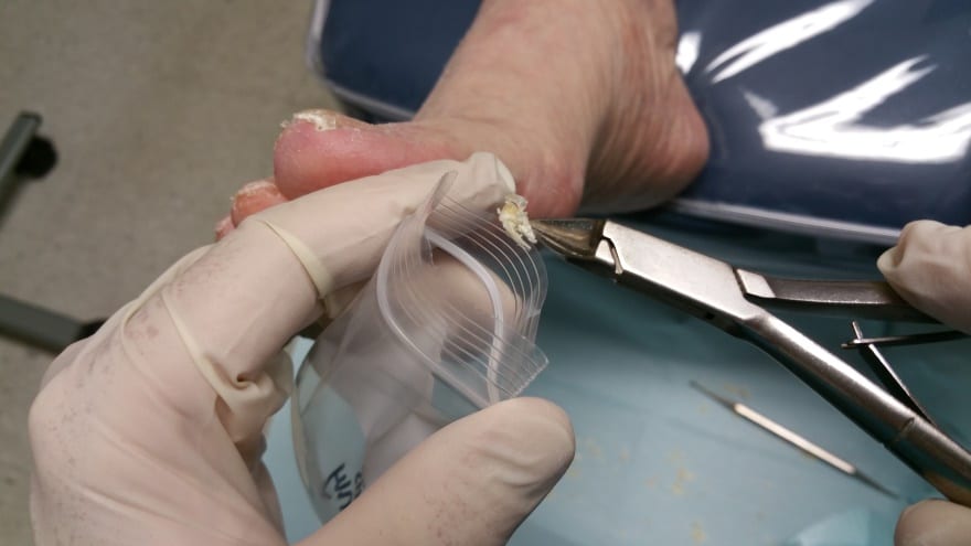 Offer Clients Convenient At-Home Kits to Test for Fungal Nails