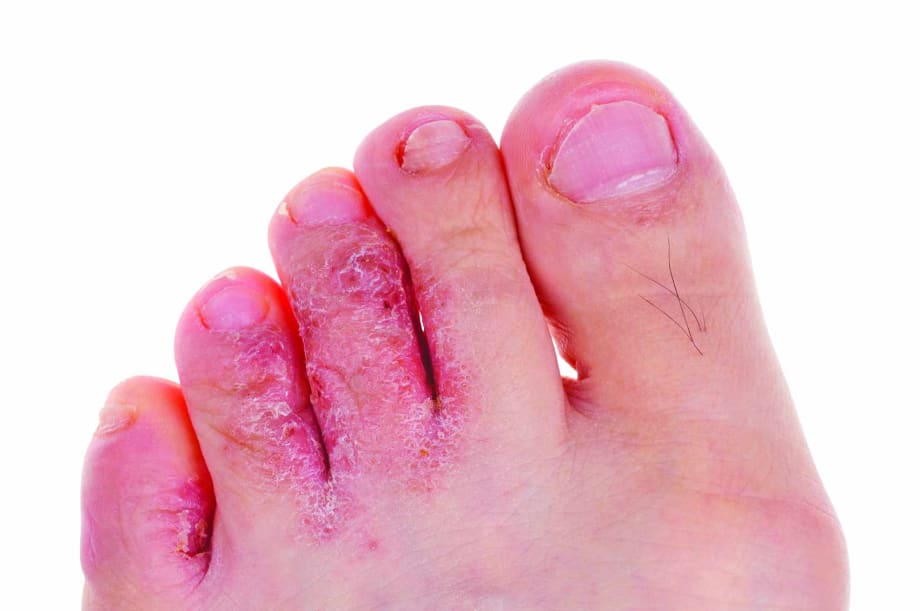 Under the Microscope: Athlete’s Foot