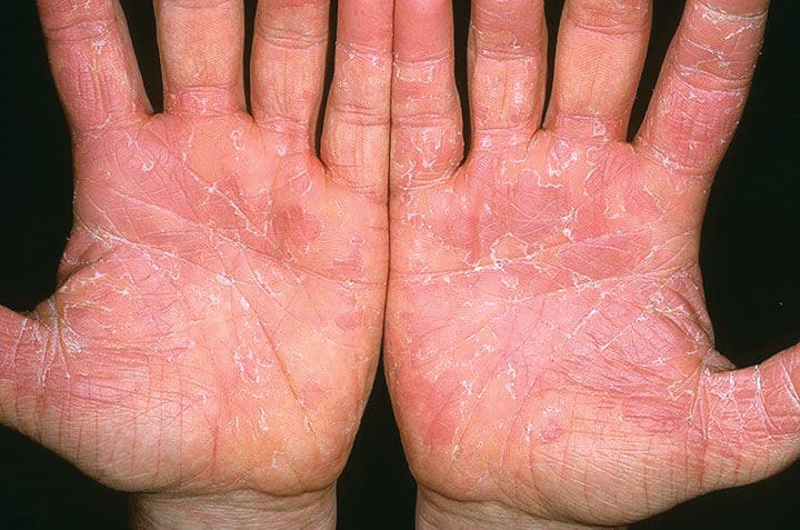 Under the Microscope: Exfoliative Keratolysis