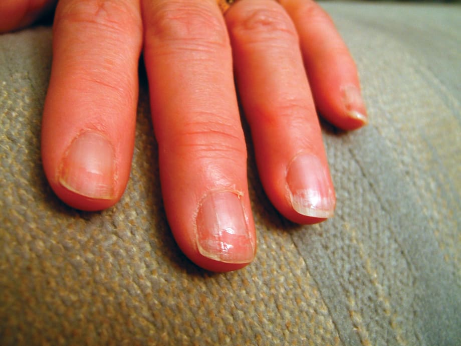 Weakened Nails After Gel Removal