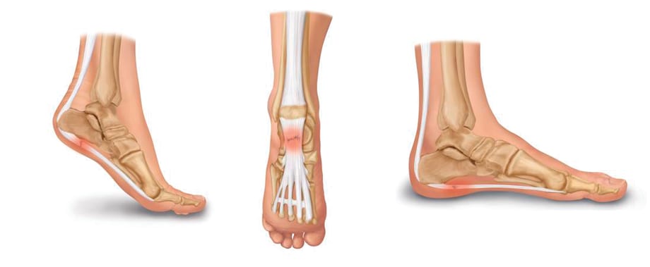 Under the Microscope: Plantar Fasciitis
