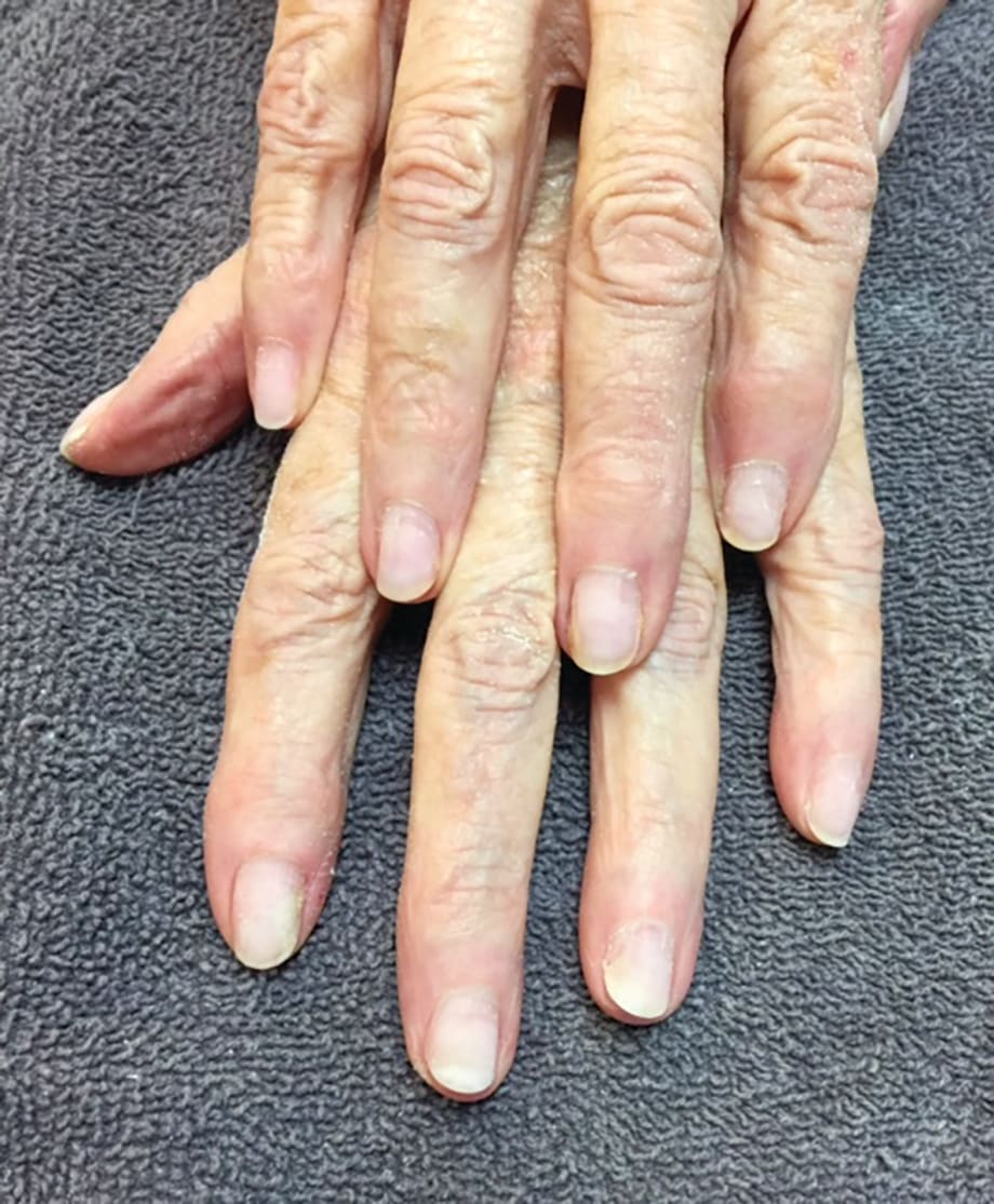 Nail Rehab: Before and After Success!