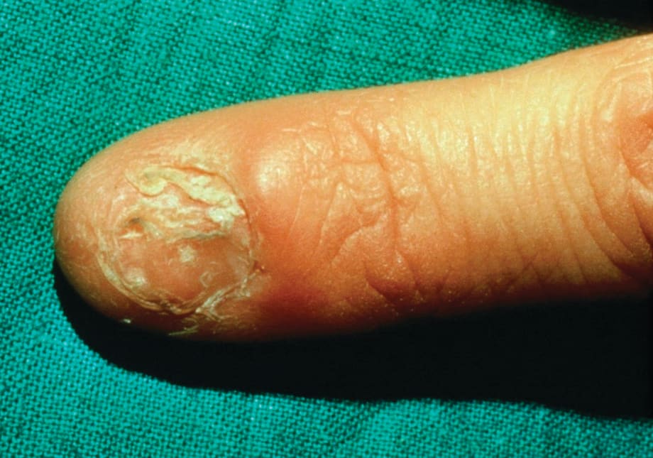 Under the Microscope: Lichen Planus