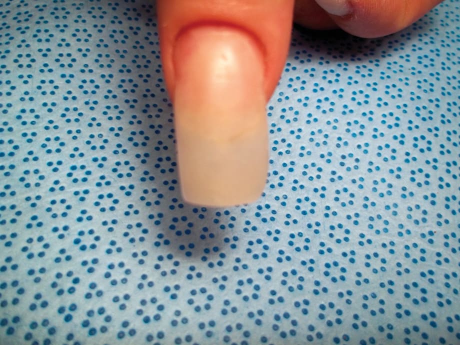 Texting Thumbnail Syndrome