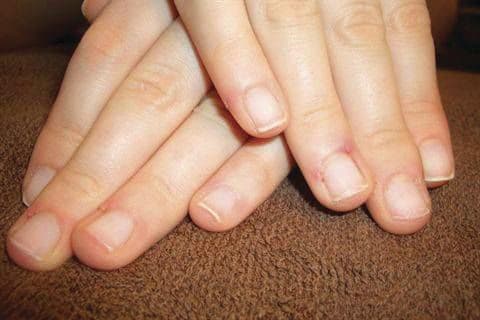 Something to Talk About: Soft, Peeling Nails