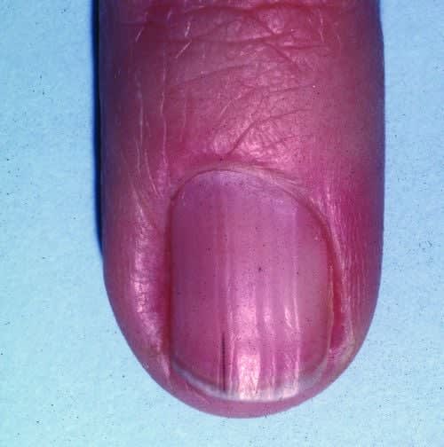Under the Microscope: Splinter Hemorrhages