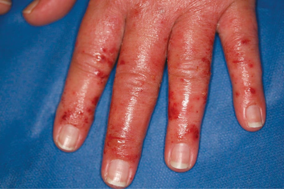 Skin Care Experts See Surge in Allergic Reactions to Nail Products